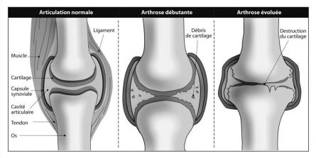 Arthrose : comment le cartilage est détruit